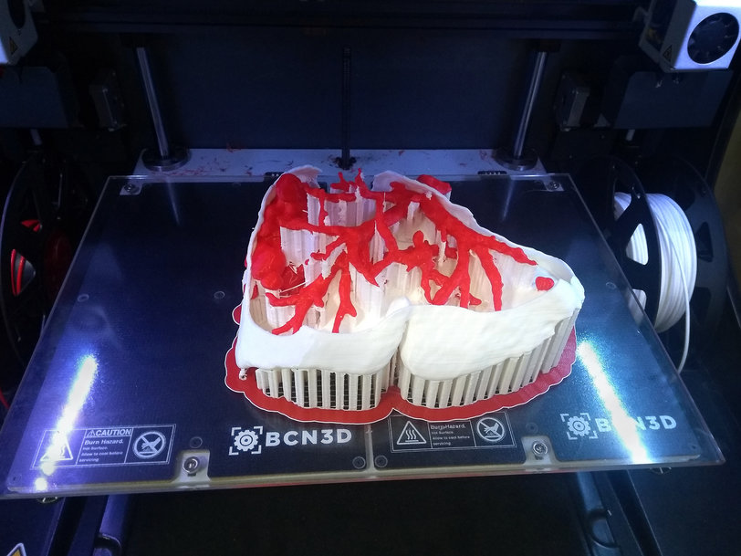 BCN3D's 3D printing technology creates biomedical models that improve cancer surgeries